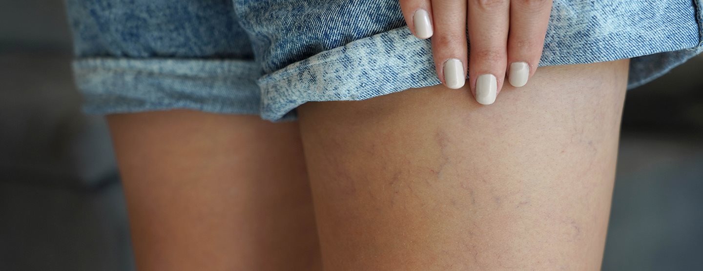 Besenreiser entfernen: Eine Dermatologin verrät, wie das geht!