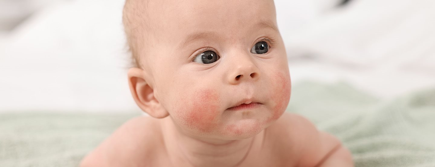 Neurodermitis, Windeldermatitis und Co.: Eine Kinderdermatologin erklärt,  was hinter den häufigsten Hauterscheinungen steckt