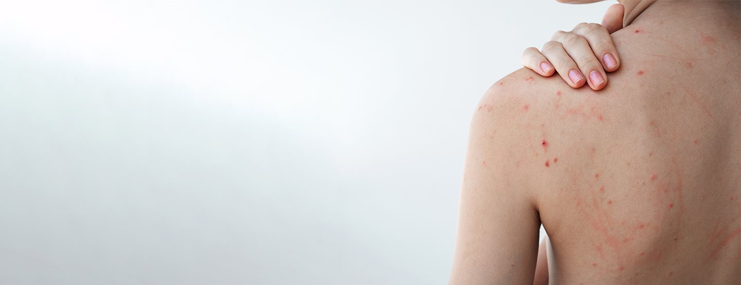 Pickel am Rücken: Das hilft laut Dermatologin wirklich gegen Bacne