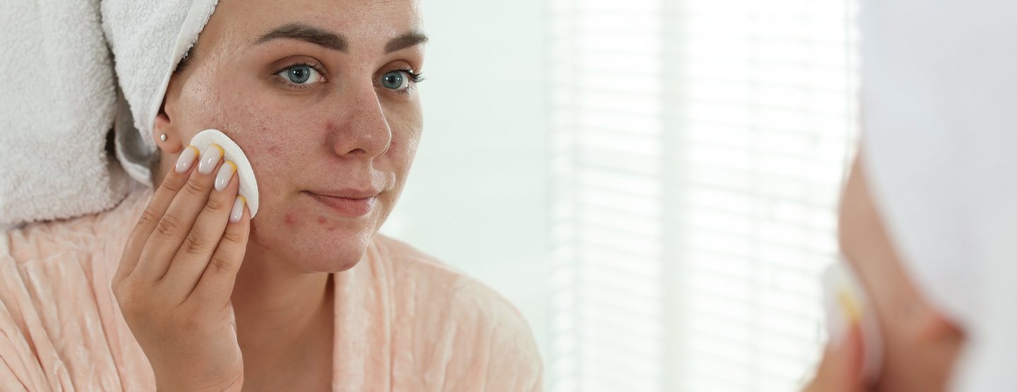 Akne tarda: Das hilft bei Erwachsenenakne!