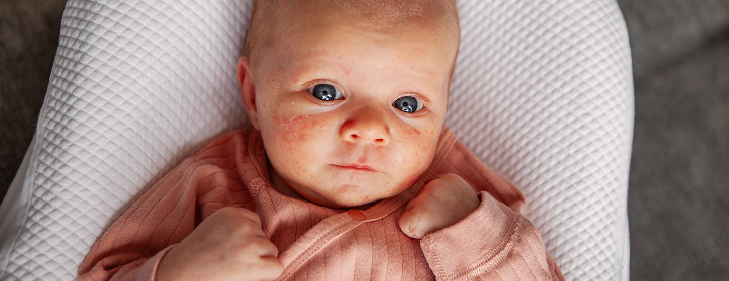 Babyakne: Das können Sie laut Kinderdermatologin dagegen tun 