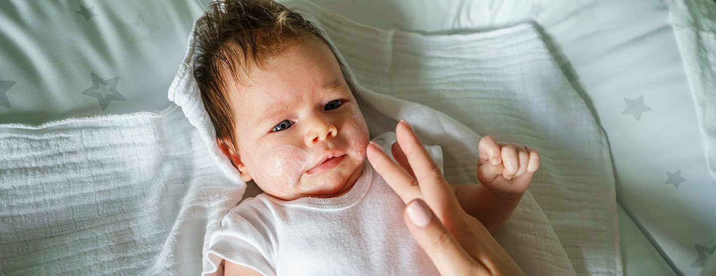Neurodermitis bei Babys und Kindern: Eine Dermatologin erklärt, was Eltern wissen sollten