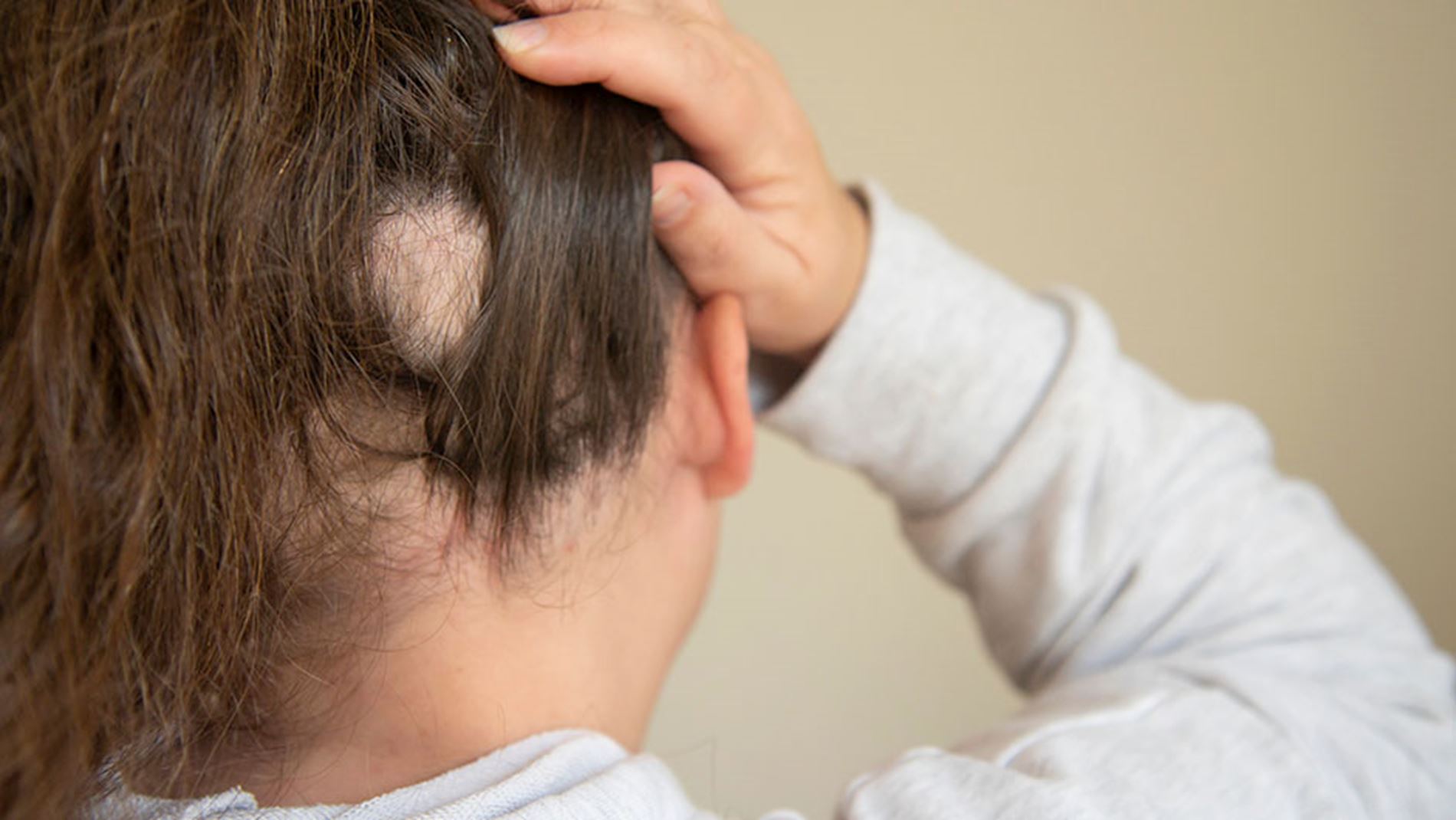 Kreisrunder Haarausfall Bei Frauen Ursache www.activebeauty.at
