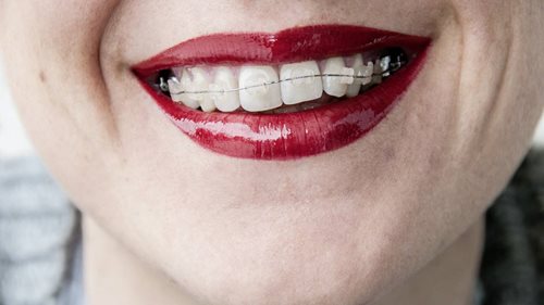 Zähne putzen mit Zahnspange – so geht’s