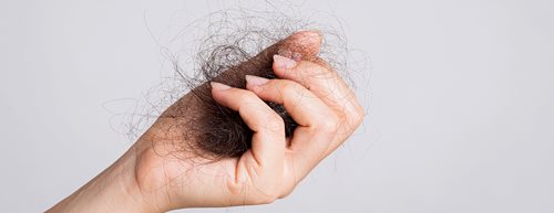 Kreisrunder Haarausfall: Was sind die Ursachen und kann man ihn heilen?