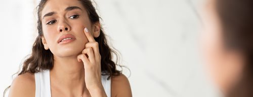 Hormonelle Akne: Das hilft gegen Pickel vor der Periode