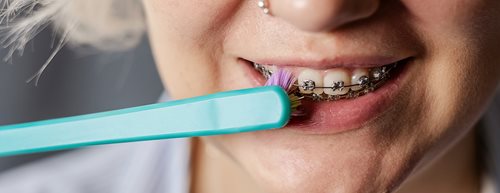 Zähne putzen mit Zahnspange – so geht’s