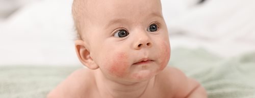 Neurodermitis, Windeldermatitis und Co.: Eine Kinderdermatologin erklärt die häufigsten Hauterscheinungen