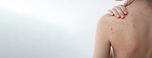Pickel am Rücken: Das hilft laut Dermatologin wirklich gegen Bacne