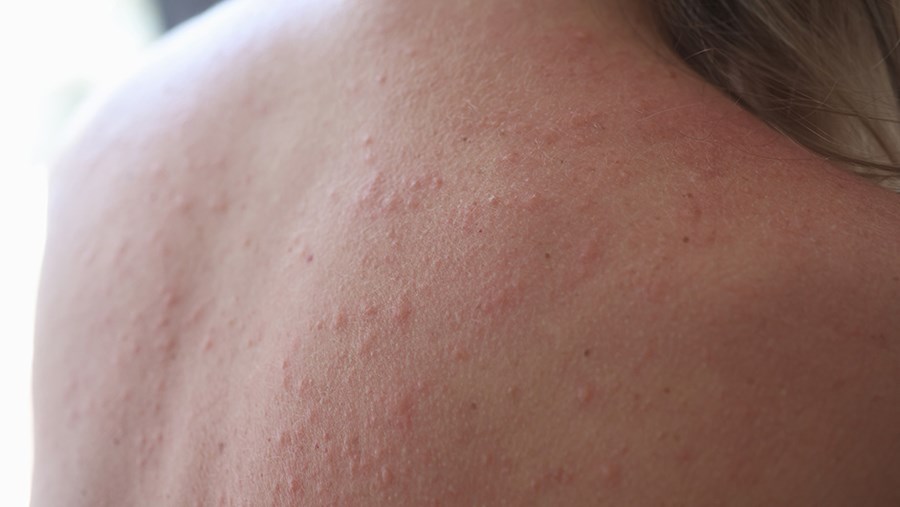 Sonnenallergie: Ausschlag am Rücken